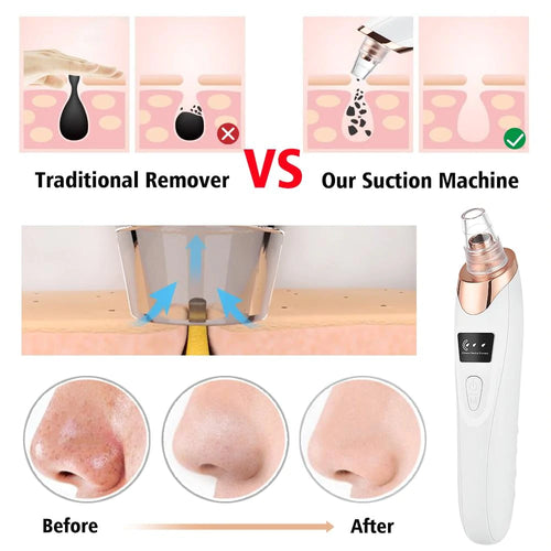 Blackhead Remover Vacuum Acne Pimple Black Spot Suction-Big Sale