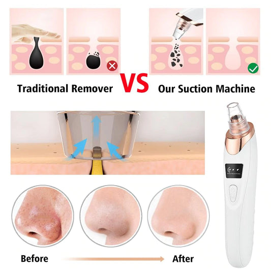 Blackhead Remover Vacuum Acne Pimple Black Spot Suction-Big Sale